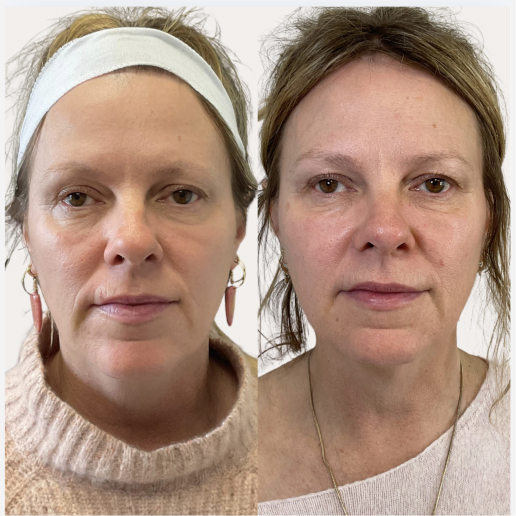 Sculptra Treatment