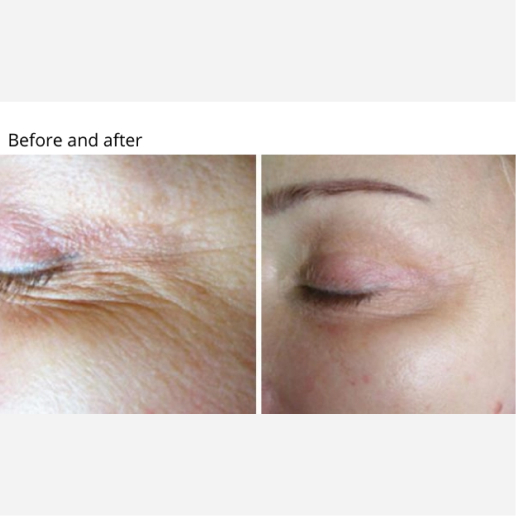 Skin Tightening & Cellulite Treatments