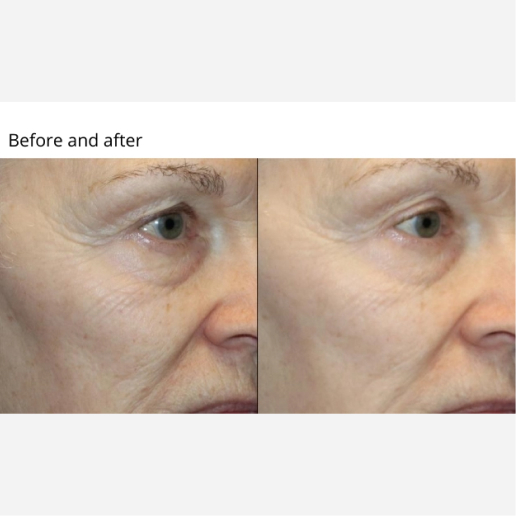 Skin Tightening & Cellulite Treatments