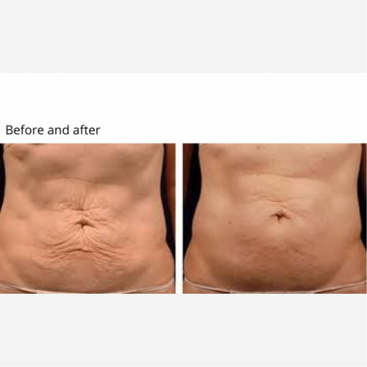 Skin Tightening & Cellulite Treatments