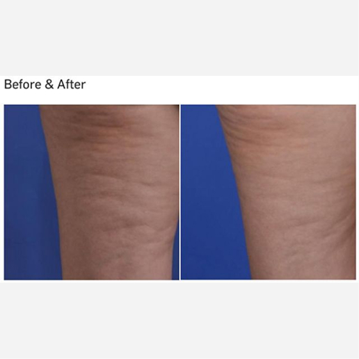 Skin Tightening & Cellulite Treatments