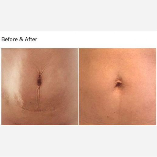 Skin Tightening & Cellulite Treatments