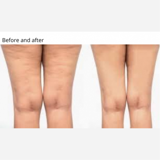 Skin Tightening & Cellulite Treatments
