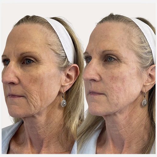 SkinVive Treatment