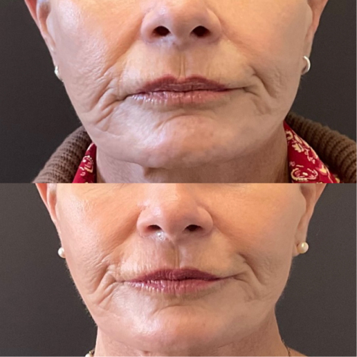 SkinVive Treatment
