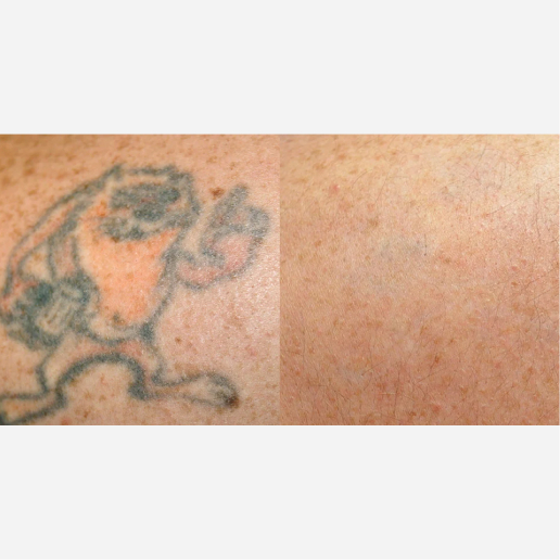 Tattoo Regrets