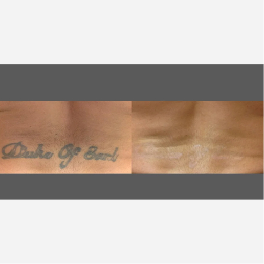 Tattoo Regrets