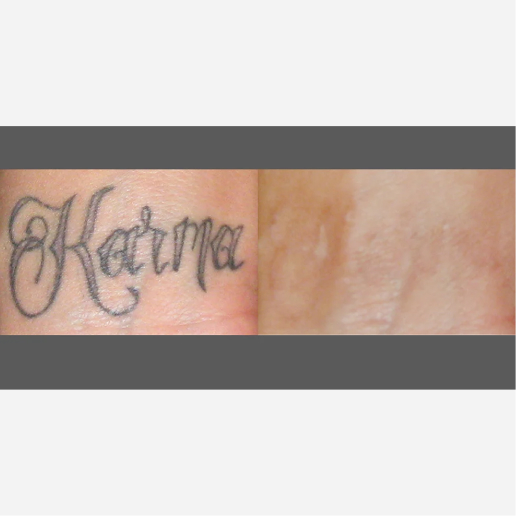 Tattoo Regrets