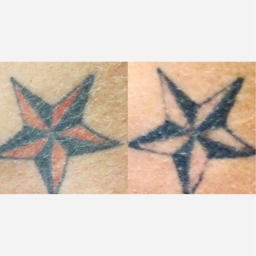 Tattoo Regrets