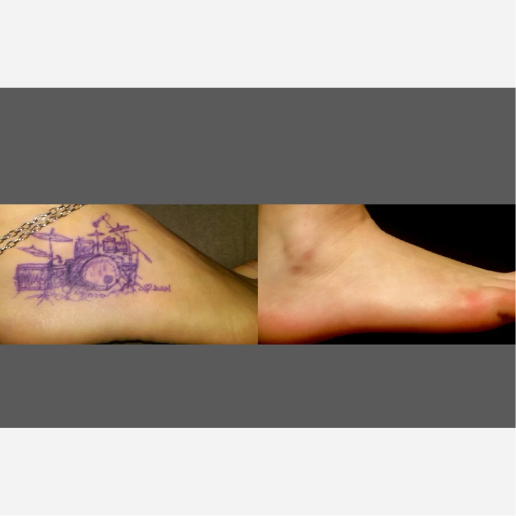 Tattoo Regrets