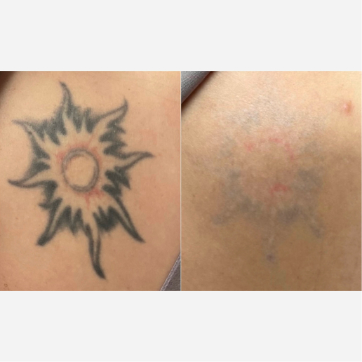 Tattoo Regrets