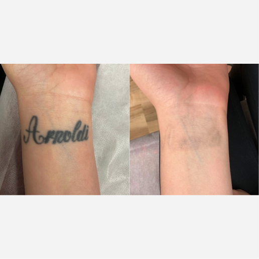 Tattoo Regrets