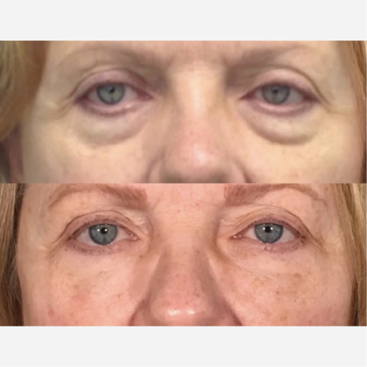 Under Eye Filler Treatment