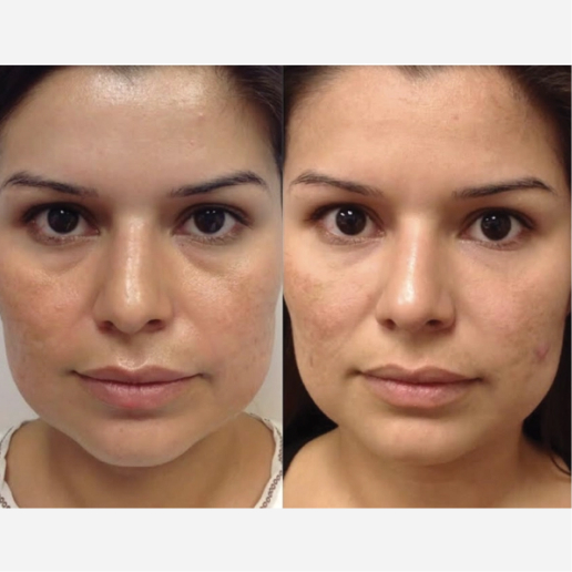 Under Eye Filler Treatment