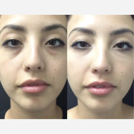 Under Eye Filler Treatment