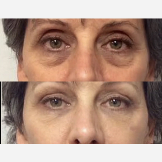 Under Eye Filler Treatment