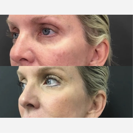 Under Eye Filler Treatment