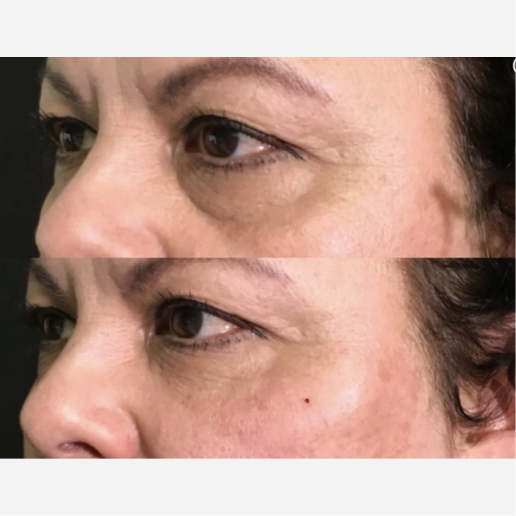 Under Eye Filler Treatment