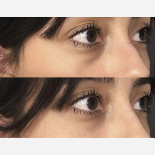 Under Eye Filler Treatment