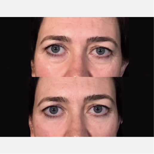 Under Eye Filler Treatment