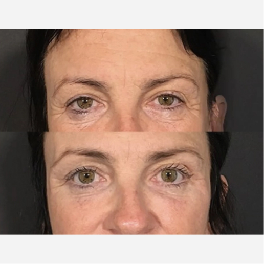 Under Eye Filler Treatment