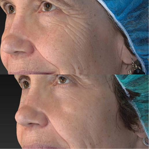 Vivace Microneedling Treatment result