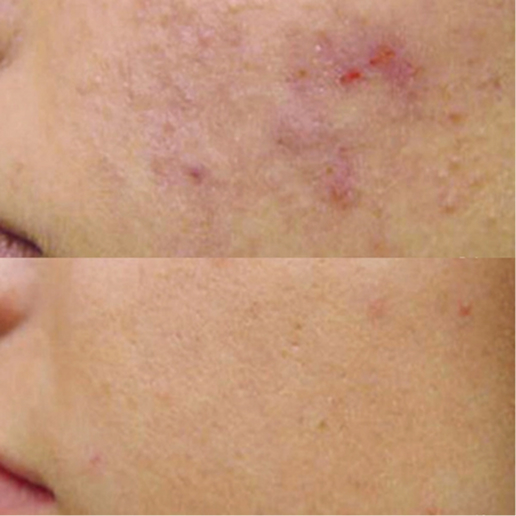 Vivace Microneedling Treatment result