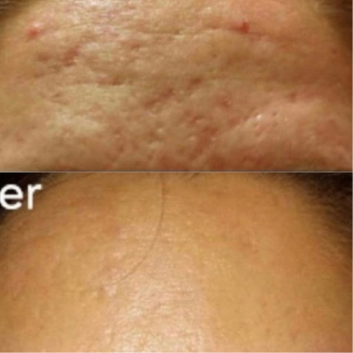 Vivace Microneedling Treatment result