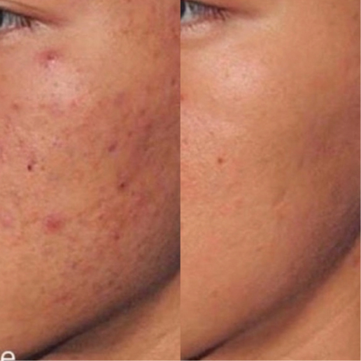 Vivace Microneedling Treatment result