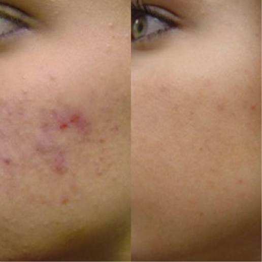 Vivace Microneedling Treatment result