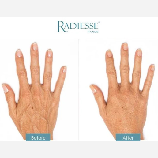 Wrinkle Treatments
