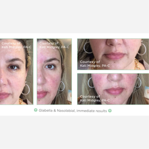 Wrinkle Treatments