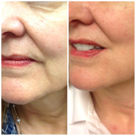 Wrinkle Treatments