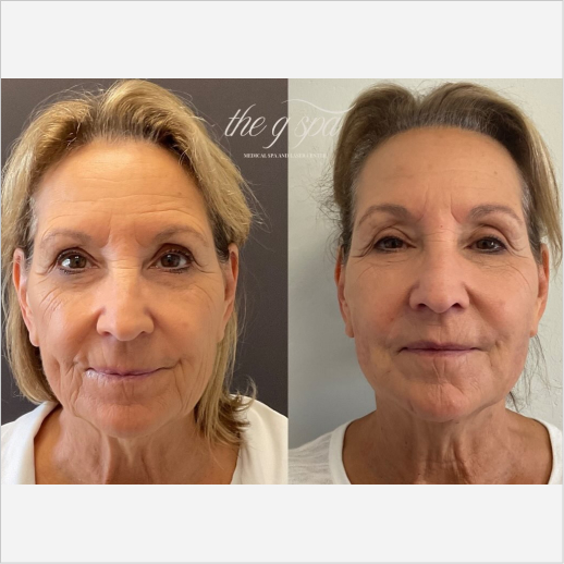 Dermal Filler