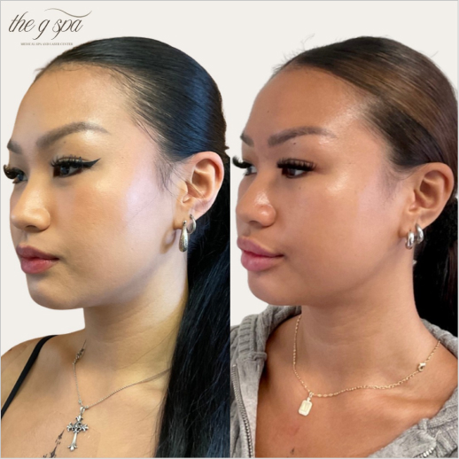 Dermal Filler