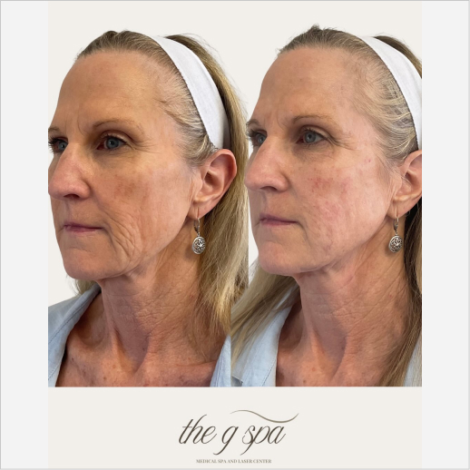Facial Balancing with Dermal Fillers