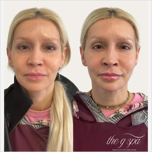 Lip Filler + EZ Gel